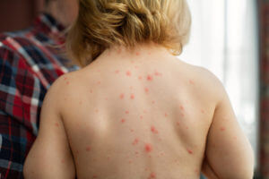 A father holding his young daughter, who has a chickenpox infection, which is a type of viral rash.